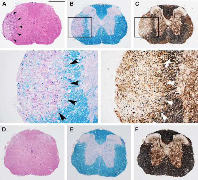 Prophylactic OM-MOG prevents the development of spinal cord neuropathology during MOG-EAE in DR2b.Ab° mice. Neuropathological analysis of spinal cord sections from prophylactic vehicle- (upper and middle panels) and OM-MOG-injected (lower panels) DR2b.Ab° mice on day 36 post-immunization for EAE. Inflammatory cell infiltration was visualized by H&E (A, D); demyelination by Luxol fast blue [(B) and enlarged inset, (E)]; axon damage by Bielschowsky's silver staining [(C) and enlarged inset, (F)]. Vehicle-treated mice show large confluent inflammatory, demyelinating lesions with axon damage typical of MOG-EAE (arrowheads). OM-MOG-vaccinated mice showed no spinal cord pathology. Scale bars 500 μM (A–F), 100 μM enlarged inserts in middle panels.