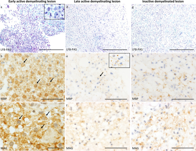 Histopathology of different demyelinating lesion activities. Panels a-c illustrate an early active demyelinating lesion, representing the initial stage of demyelination. At this stage, degradation products from both major (e.g., MBP) and minor (e.g., MAG) myelin proteins are present within phagocytes. a LFB/PAS staining reveals a demyelinated lesion containing multiple foamy macrophages. The inset shows an enlarged microscopic image of foamy macrophages with LFB-positive myelin debris; b Anti-myelin basic protein (MBP) staining of the early active lesion reflects myelin destruction and highlights numerous macrophages filled with myelin degradation products; c Anti-myelin-associated glycoprotein (MAG) staining also shows multiple macrophages containing MAG-positive degradation products, a minor myelin protein. Panels d-f depict a late active demyelinating lesion, representing the subsequent stage of demyelination, where only degradation products from major myelin proteins (e.g., MBP) can be identified within phagocytes. d LFB/PAS staining shows a completely demyelinated lesion with reactive astrogliosis and foamy macrophages; e Anti-MBP staining reflects an advanced stage of demyelination, with only a few macrophages containing MBP-positive degradation products (see inset for MBP-positive macrophages); f In contrast, no degradation products from minor myelin proteins, such as MAG, are detected within macrophages, as demonstrated by anti-MAG staining. Panels g-i present an inactive demyelinated lesion, where no active demyelination processes are observed. g LFB/PAS staining reveals a demyelinated lesion accompanied by reactive astrogliosis and foamy macrophages; h Anti-MBP staining shows newly formed, thin myelinated fibers, indicating early remyelination. However, no myelin degradation products are observed within macrophages; i Anti-MAG staining also identifies early remyelination. LFB/PAS Luxol fast blue/periodic acid-Schiff, MBP myelin basic protein, MAG myelin-associated glycoprotein, Scale bars: a, d and g 200 um; b, f and i 50 um; e and h 100 um; c 20 um