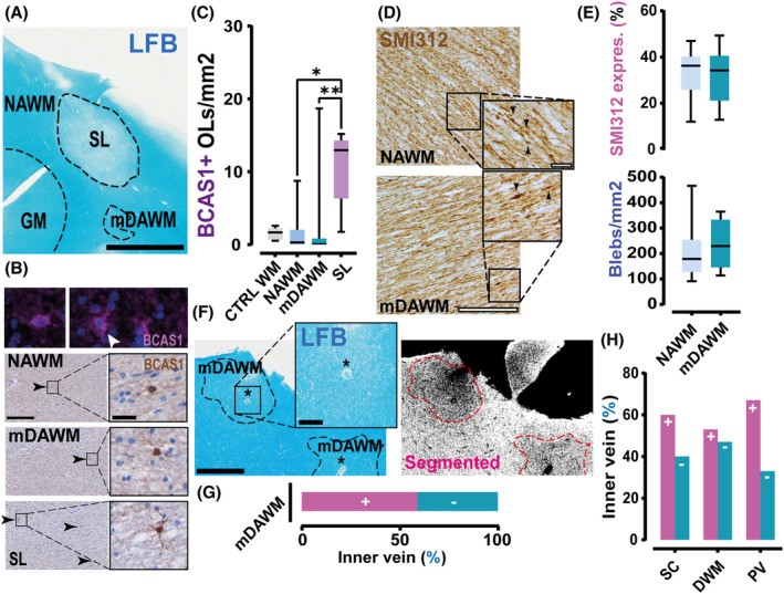 Luxol fast blue (LFB) and proteolipid protein (PLP) immunostaining of human white matter from an MS brain, showing micro-diffusely abnormal white matter (mDAWM) with focal myelin swellings characteristic of an early pre-demyelinating lesion.